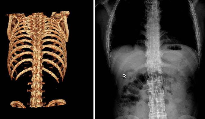 强直性脊柱炎的临床诊断,强直性脊柱炎诊断标准与治疗