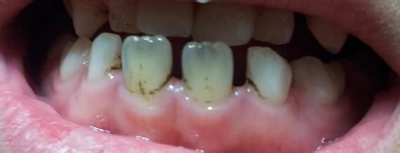 为什么有的孩子牙齿会长黑斑,为什么孩子的牙齿老是长黑斑