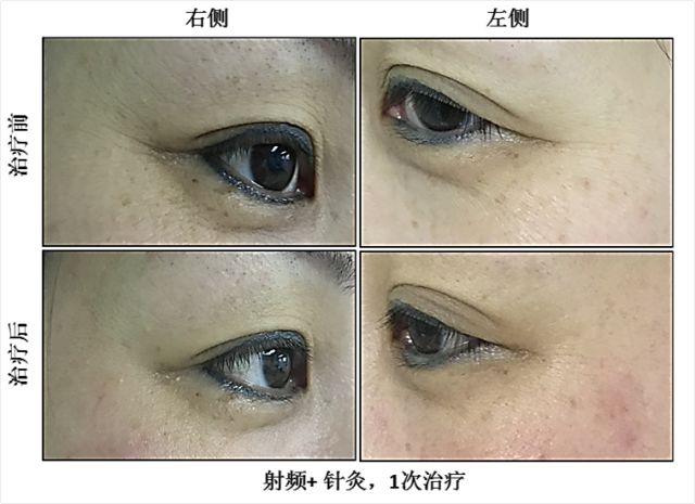 针灸抗衰老秘诀有哪些,针灸哪个穴位可以延缓衰老