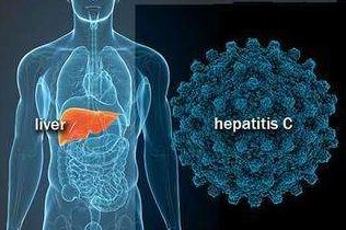 治疗丙肝最好的养生药,丙肝自愈的秘诀