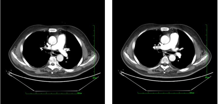 急性心梗病例讨论的意义,急性肺栓塞和急性心肌梗死