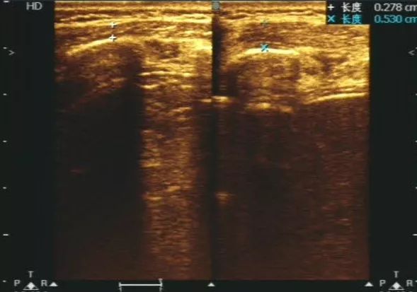 超声提示不发育了怎么回事呢,超声检查不硬咋办