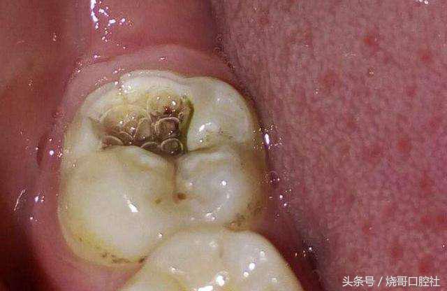 牙神经死掉牙齿发黑,五岁儿童牙神经坏死牙发黑怎么办
