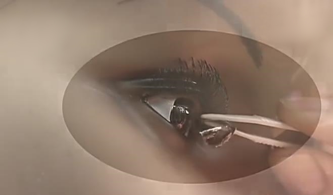 烤火隐形眼镜融化,烧烤戴隐形眼镜会融化吗