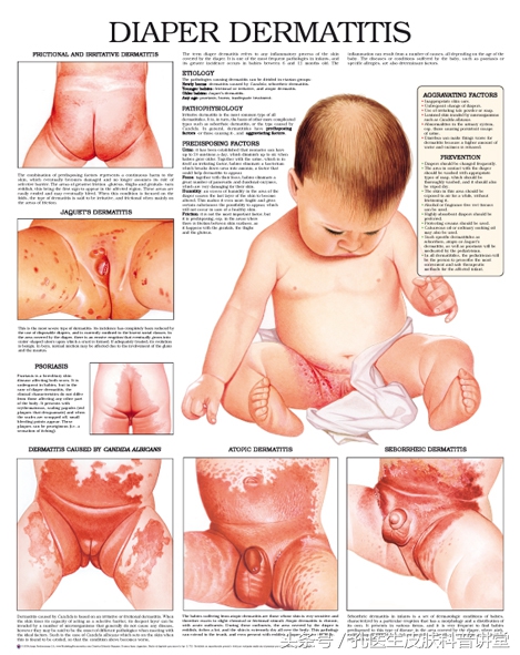尿布疹红臀的预防和护理,新生儿尿布皮炎红臀的原因分析
