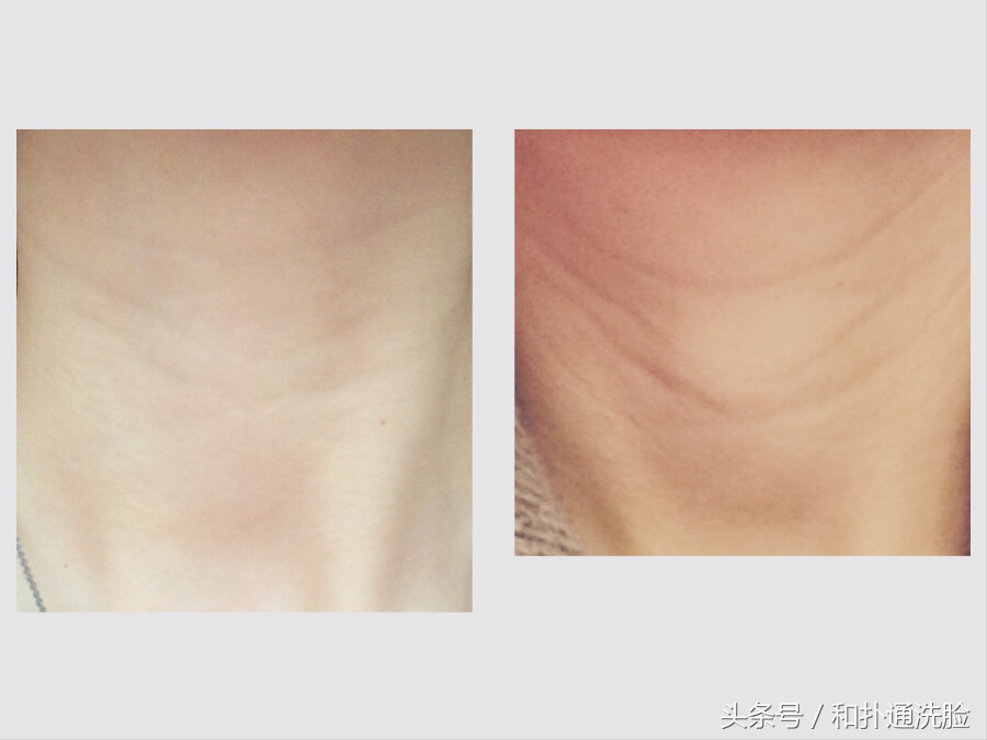 逆龄美力︱颈纹说你几岁了？