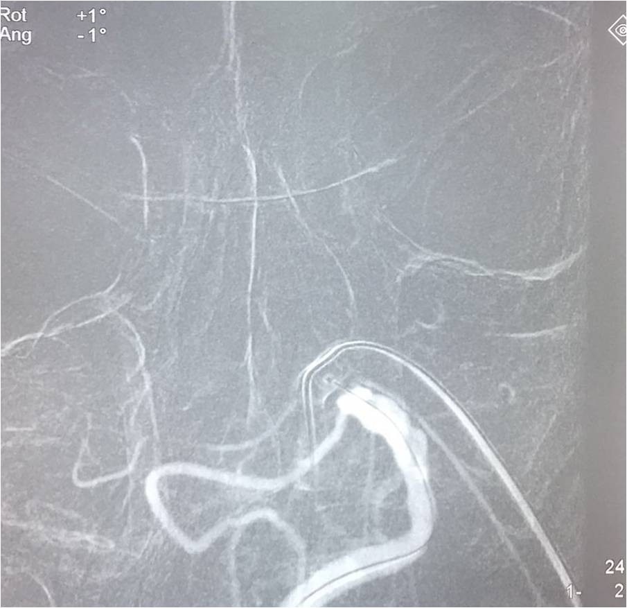 取栓慢性闭塞如何避免血栓逃逸,急性大脑中动脉栓塞取栓时间