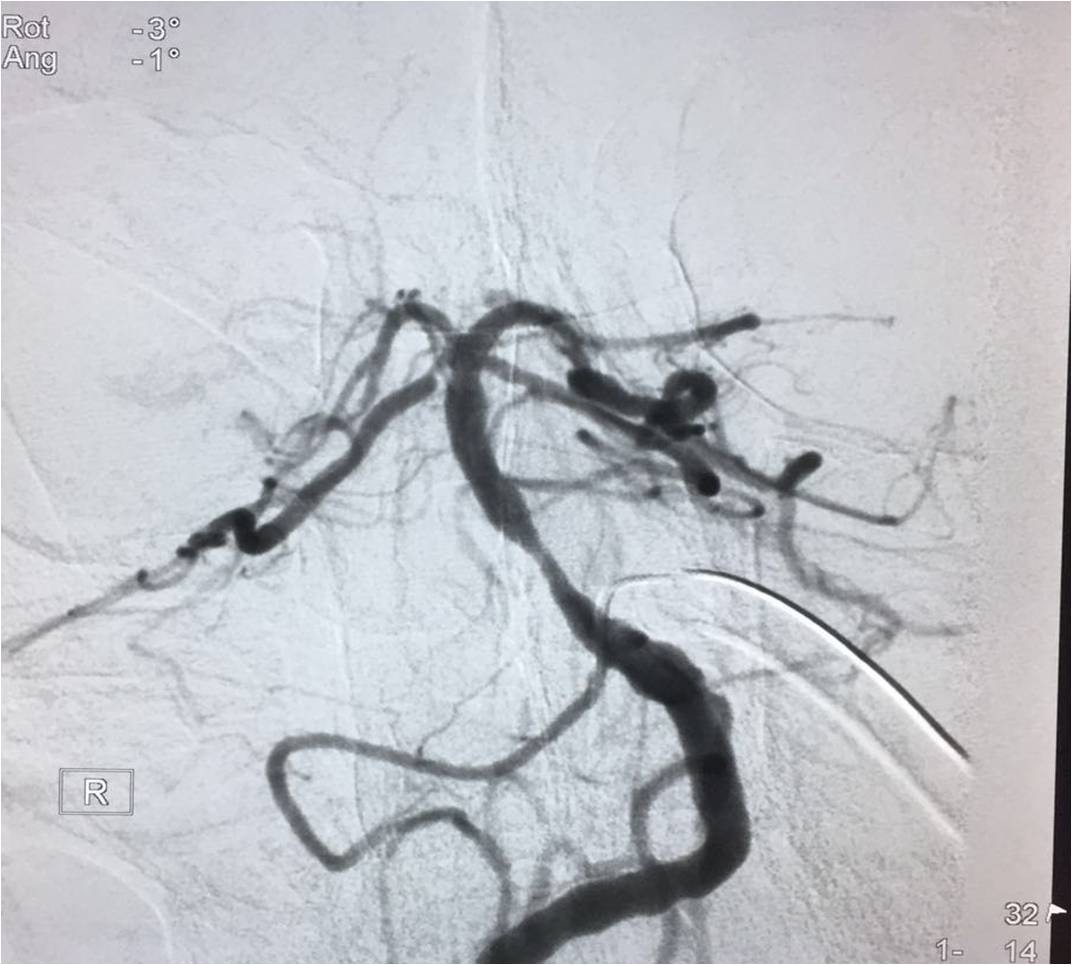 取栓慢性闭塞如何避免血栓逃逸,急性大脑中动脉栓塞取栓时间