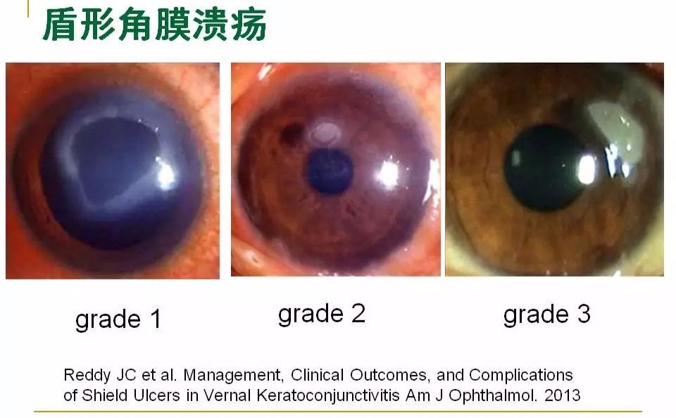眼周过敏中医治疗,眼周过敏的症状图片