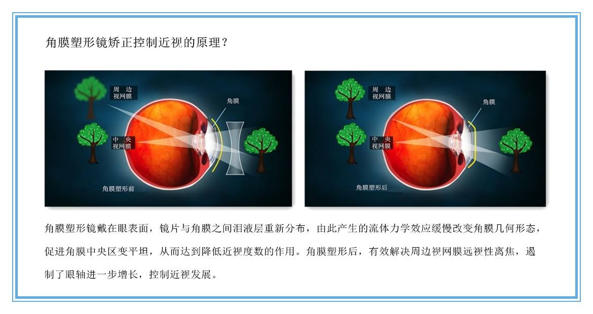 近视角膜塑形镜的利与弊,近视矫正角膜塑形镜价格