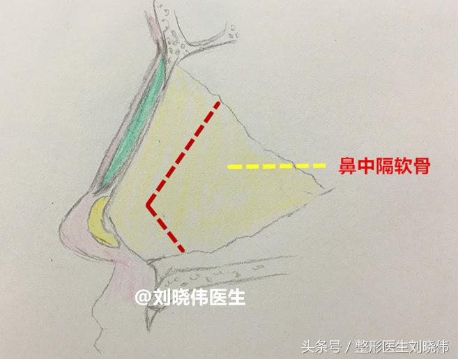 小鼻综合和大鼻综合的区别,鼻整形科普