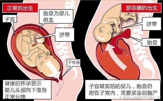 子宫破裂最主要的诱因是,怎么预防瘢痕子宫的破裂