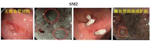 内镜检查痛苦吗,内镜检查是怎么做的