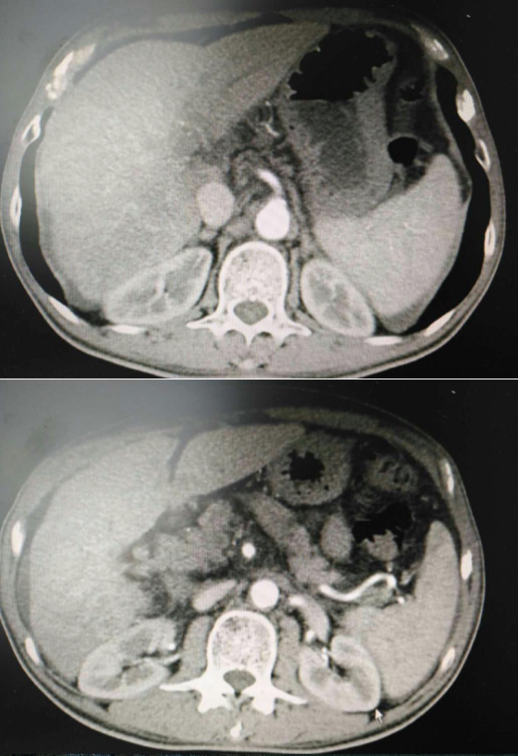 周仲国评价肝癌病例,周仲国分享肝癌早期复发