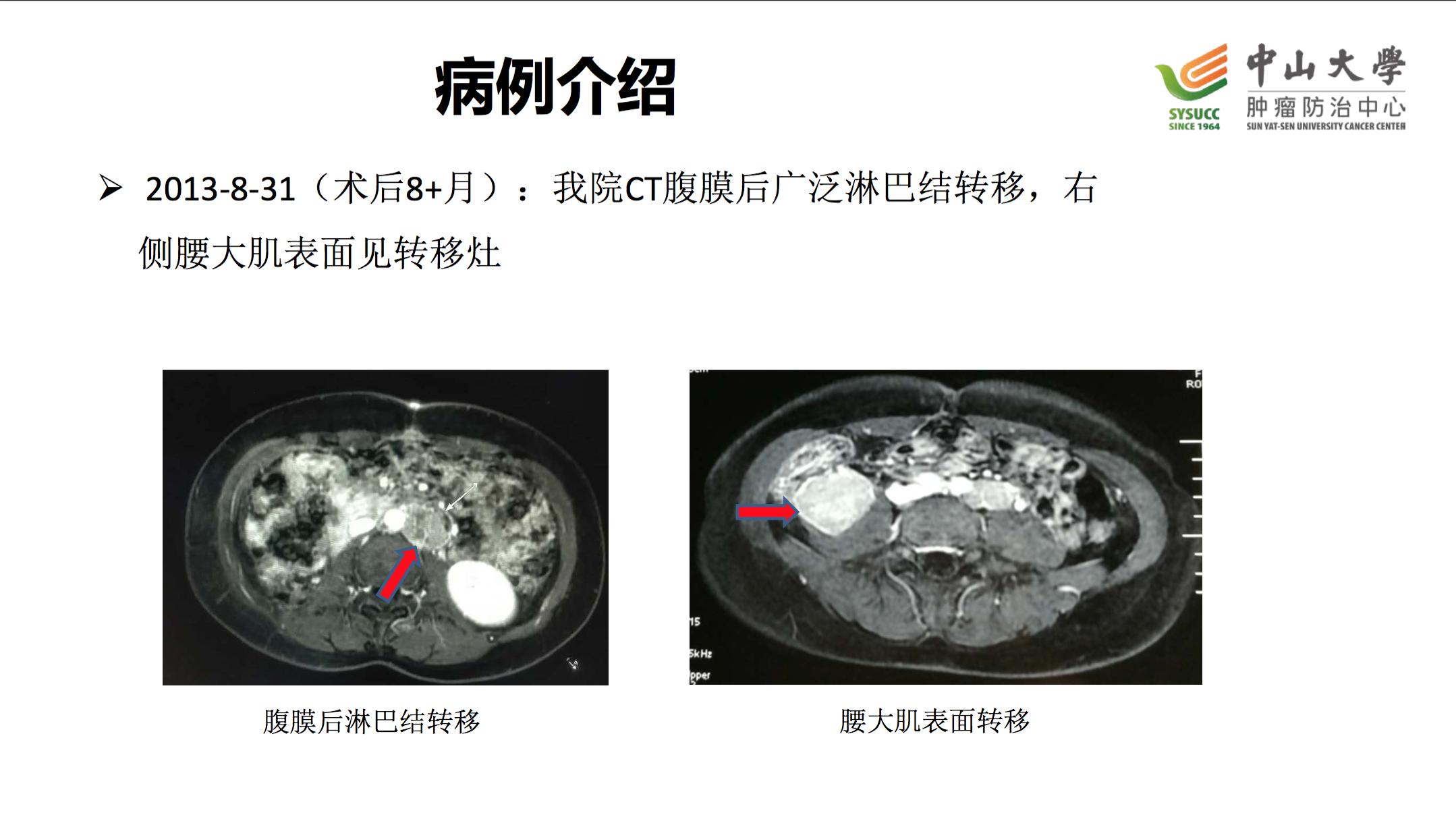 阿昔替尼联合pd-1治疗肾癌,肾癌阿昔替尼耐药后怎么治疗