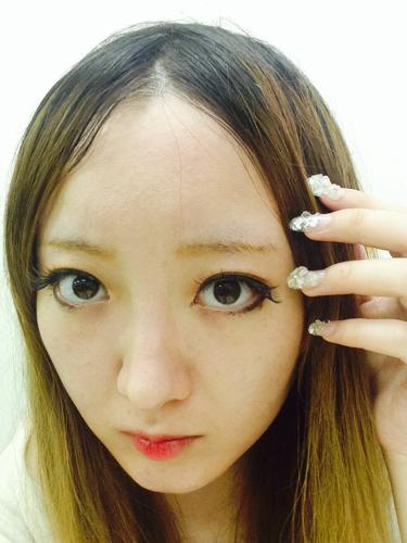 发际线高植发要多少钱一般,发际线略高植发需要多少钱