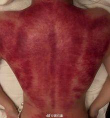 阿娇刮痧,阿娇背部刮痧图片