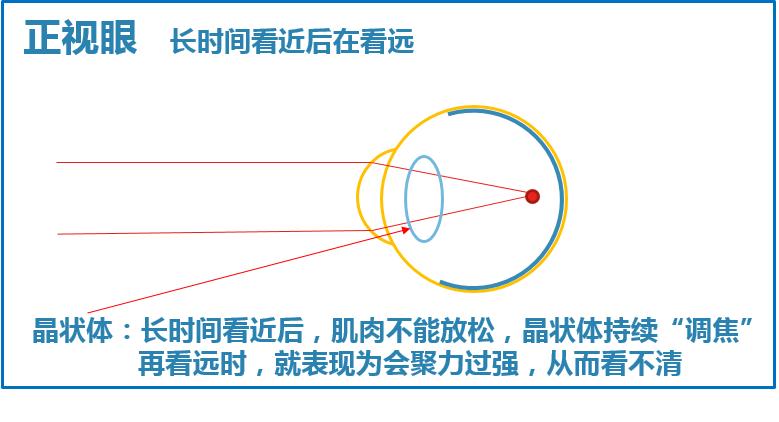 近视后有什么方法可以缓解近视,如何在短时间内恢复近视
