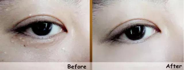 不用针挑刺,不用针挑刺还有什么办法能挑