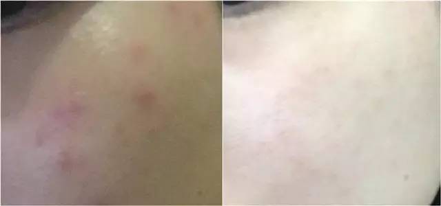 亲测｜烂脸才知道Albion健康水有多好