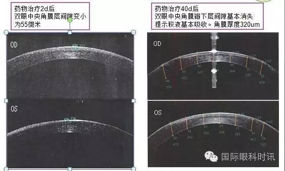 角膜水肿的处理方法,眼睛角膜水肿后遗症