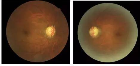 苏世独”例“晚期原发性开角型青光眼1例
