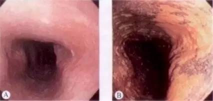 早期食管癌用内镜可以根除吗,超声内镜可以查出早期食管癌吗