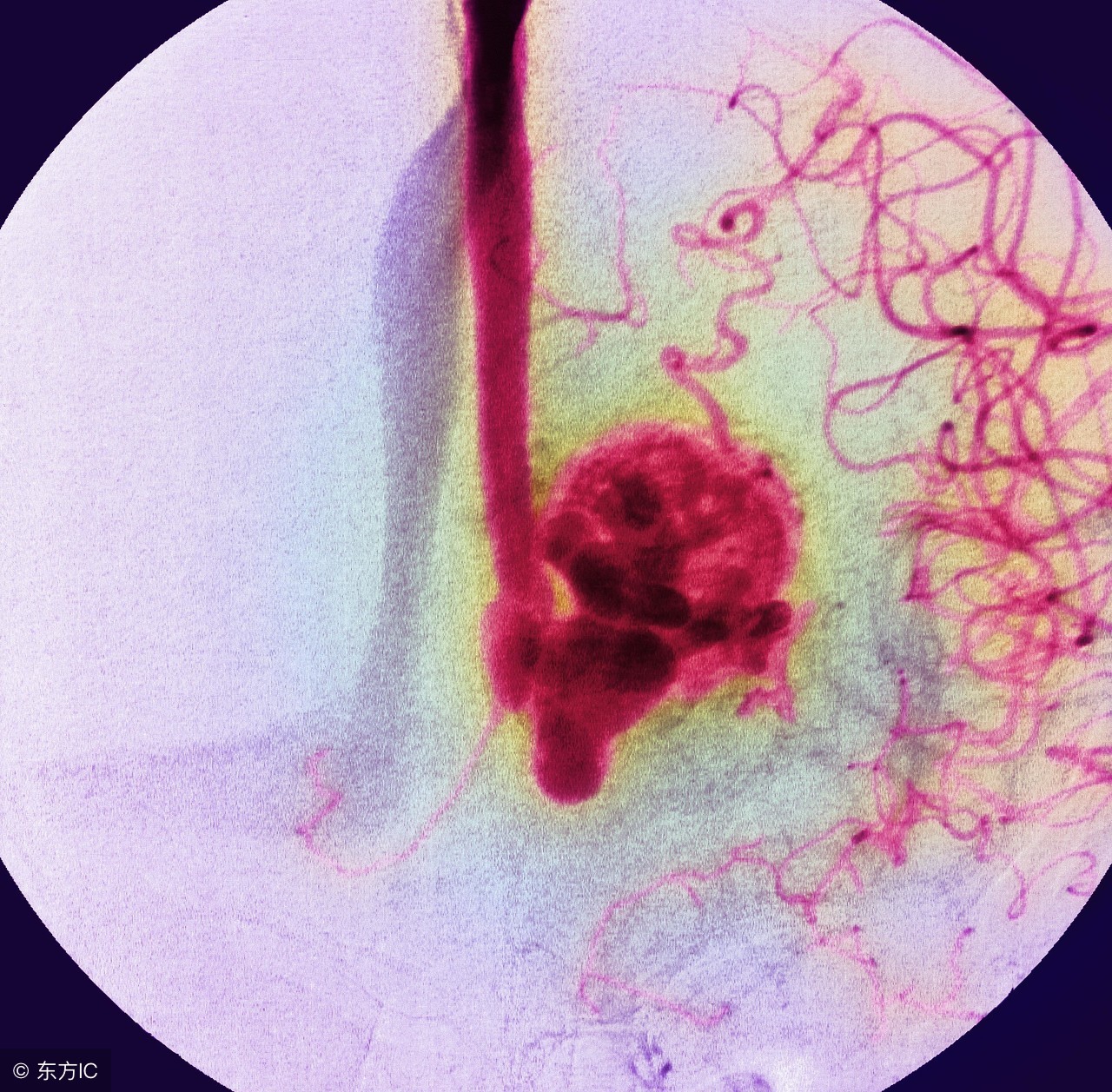 血管瘤该怎么治疗,血管瘤要怎么治疗才能好