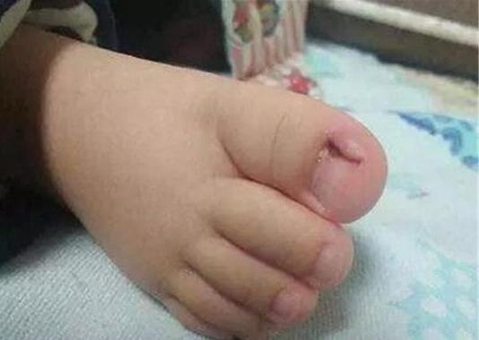 治疗甲沟炎的偏方花椒和啥,孩子得了甲沟炎怎么自己治疗