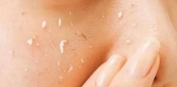 鼻子上白头粉刺怎么彻底去除,面部白头闭口粉刺怎么去除