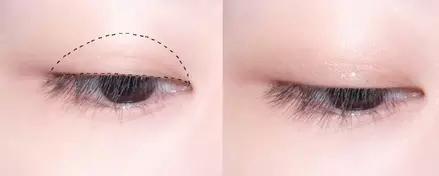 单眼皮适合割什么双眼皮,单眼皮不想割双眼皮有什么办法