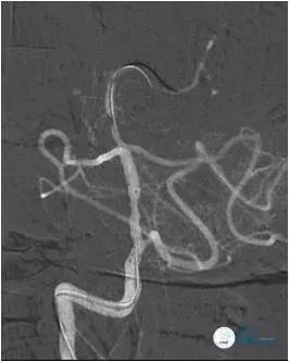 天坛医院做椎动脉狭窄多少要手术,天坛椎动脉狭窄