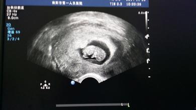 孕妈b超单怎么看,如何看懂b超影像里哪个是胎儿