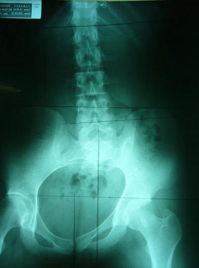 屁股歪了,屁股歪了最佳治疗方法