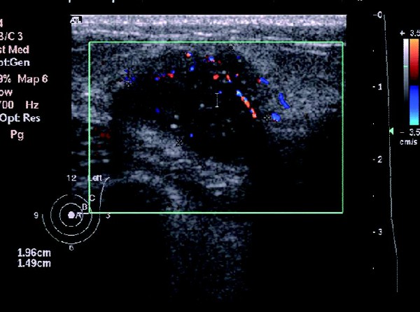 乳腺癌的超声图像表现,早期乳腺癌的超声表现