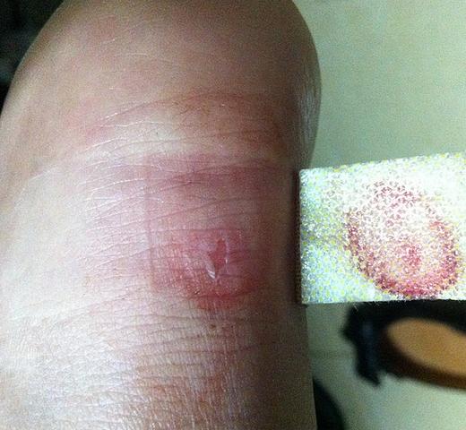 女士皮鞋后跟打脚怎么处理,皮鞋打脚有什么方法解决