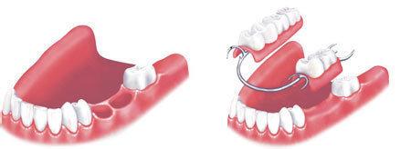 牙齿缺损多少可评残疾,牙齿楔状缺损初期图片