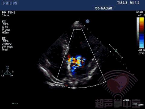 经典病例▏二尖瓣囊肿中竟然全是血液？