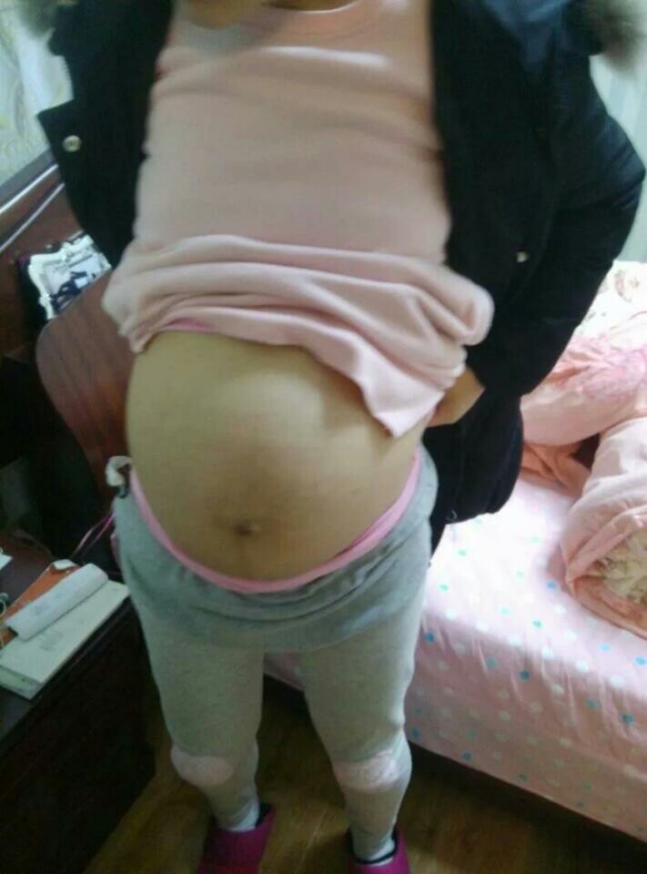 剖宫产前一天嘴馋,剖腹产前暴饮暴食