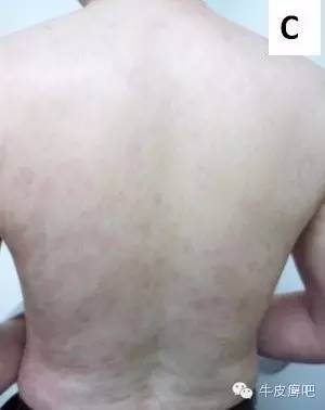 皮肤科专家谈论银屑病生物制剂,中国治疗银屑病新药生物制剂