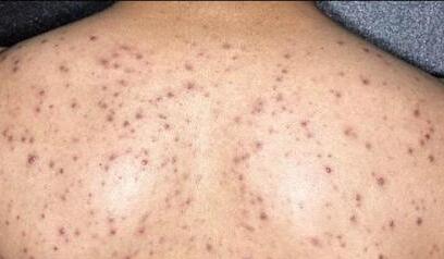 背部长痘解决方法,背部长痘怎么祛痘印小妙招