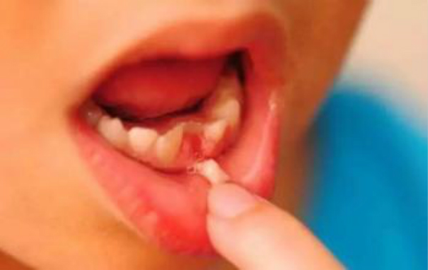 儿童牙齿意外伤怎么赔偿,一些预防儿童牙齿意外的方法