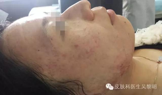 透明质酸护肤品功效,透明质酸是修复皮肤敏感成分