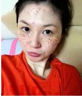 怎样治疗脸上的色素斑,色素斑怎么消除最快最有效