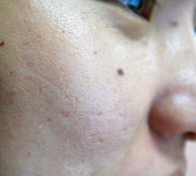 皮肤干燥该怎么做护肤,冬季皮肤干燥粗糙怎么护肤