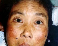 常见黑斑产生的6大因素，了解才能更好解决