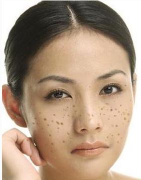 雀斑怎么祛除不花钱1天就好,祛除老年斑色斑雀斑的好方法