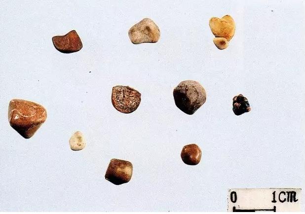 清除尿道结石,帮助尿道结石排出的最好办法