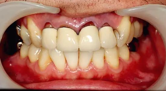 活动假牙戴不住，种植牙又嫌贵该怎么办？