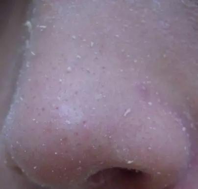 为什么粉刺不挤也有印子,为什么粉刺老是挤不干净